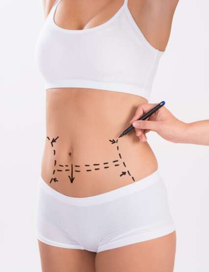 Tummy Tuck